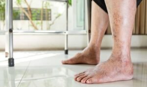 Diabetic Foot